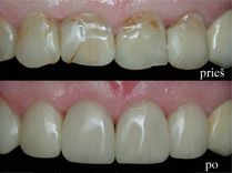 Estetinis plombavimas – šypseną gražinantis stebuklas