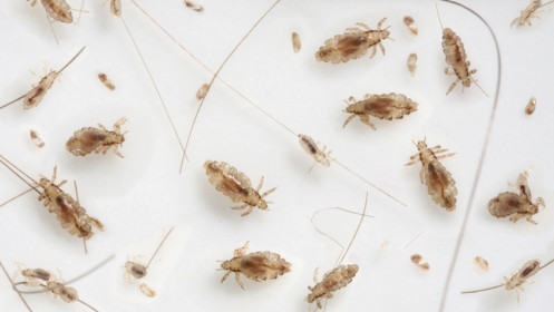 Problema JK mokyklose: kokiame amžiuje gyvename, jog vaikai vis dar turi utėlių?