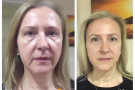 Londono lietuvės turi galimybę atjaunėti 10-imčia metų