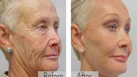 Londono lietuvės turi galimybę atjaunėti 10-imčia metų