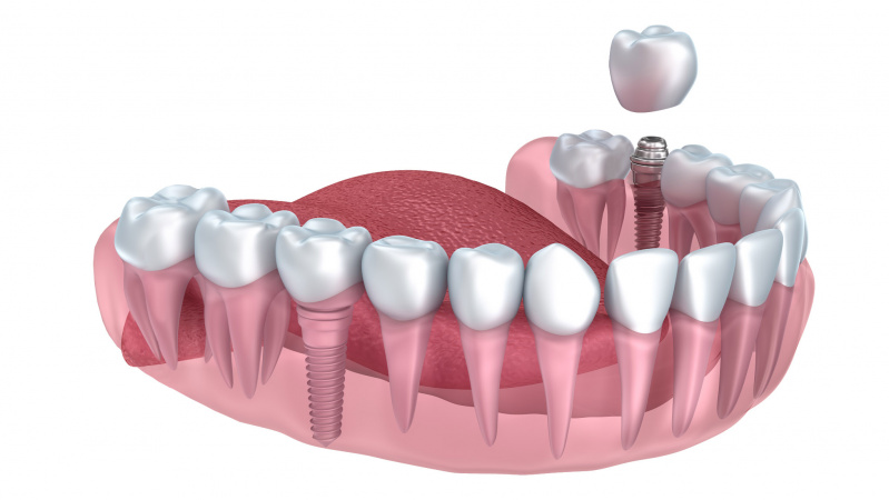 Visa tiesa apie dantų implantus: kai kokybė svarbiau nei kaina 