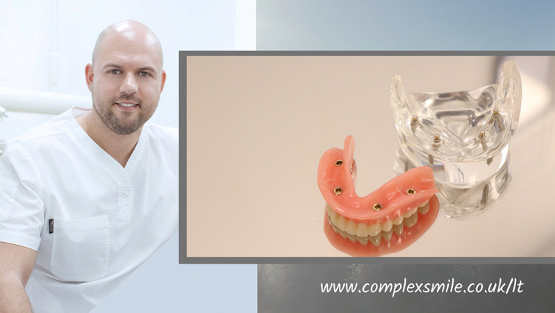 Nuo šiol tobula šypspena įkandama visiems: Nauji dantys klinikoje Londone vos už £21 per savaitę