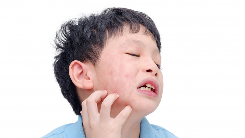 Anglijoje daugėja kiaulytės ir tymų atvejų, studentai raginami skiepytis