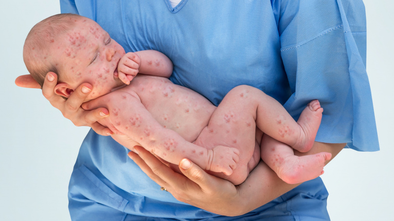 JK – tarp keturių Europos šalių, kur tymai nebelaikomi išnaikinta liga