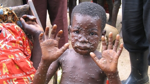 Londono ligoninėje gydomas beždžionių raupais užsikrėtęs žmogus