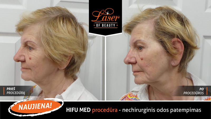 Odos patempimas be skalpelio? Su HIFU tai pasiekiama ir JK lietuviams
